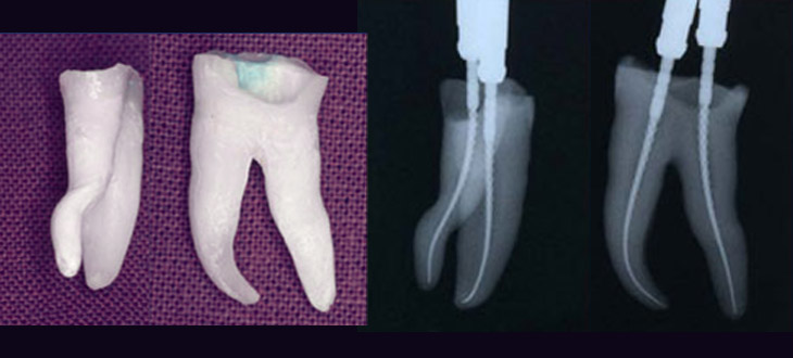 Wurzelkanalbehandlung / ENDODONTIE - Beispiel extremer Wurzeln, die mit herkömmlichen Methoden nicht erfolgreich zu behandeln sind.